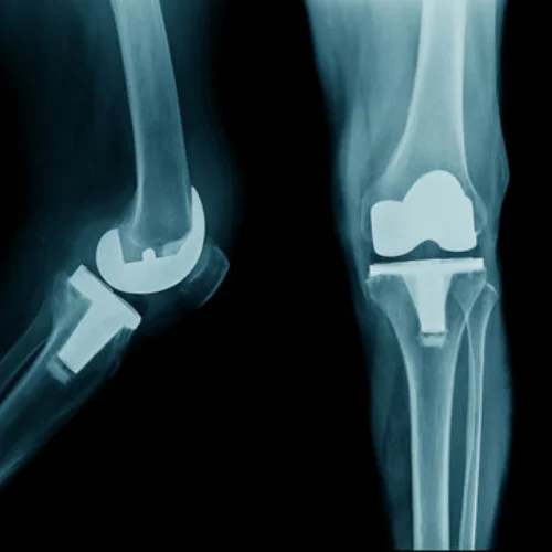 Arthritis