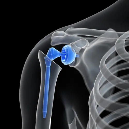 Arthritis