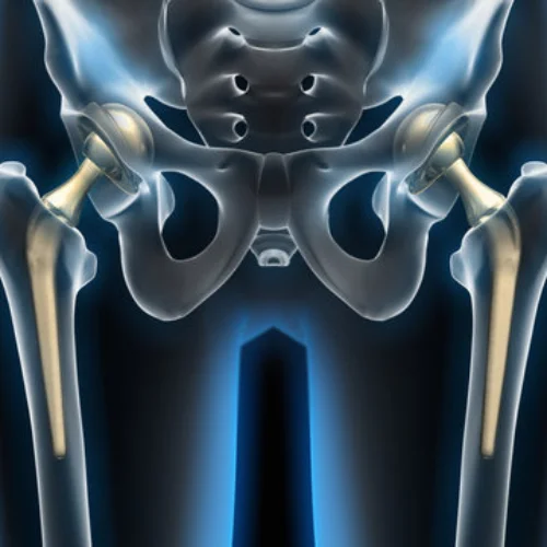 Arthritis