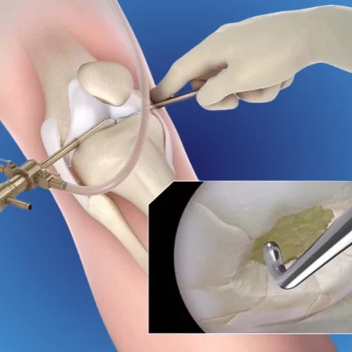Arthroscopy
