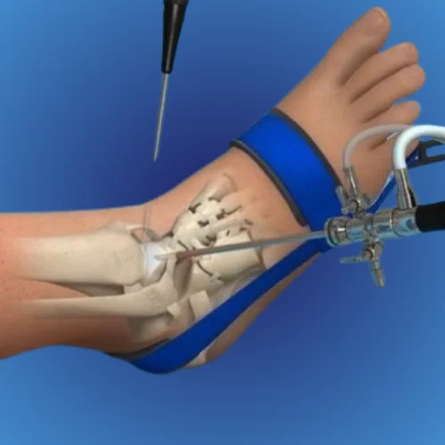 Arthroscopy