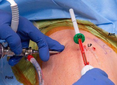 InSpace Balloon Surgery | Treatment for Rotator Cuff Tears