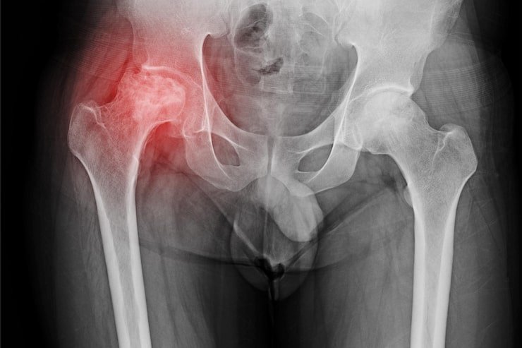 Myth-Busting: 7 Common Hip Replacement Myths Debunked by Experts