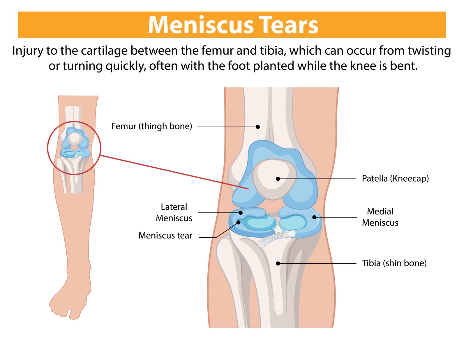 Meniscus Repair Surgery: Complete Guide