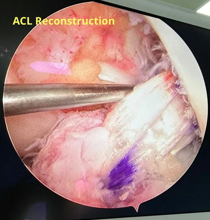 PRP Treatment