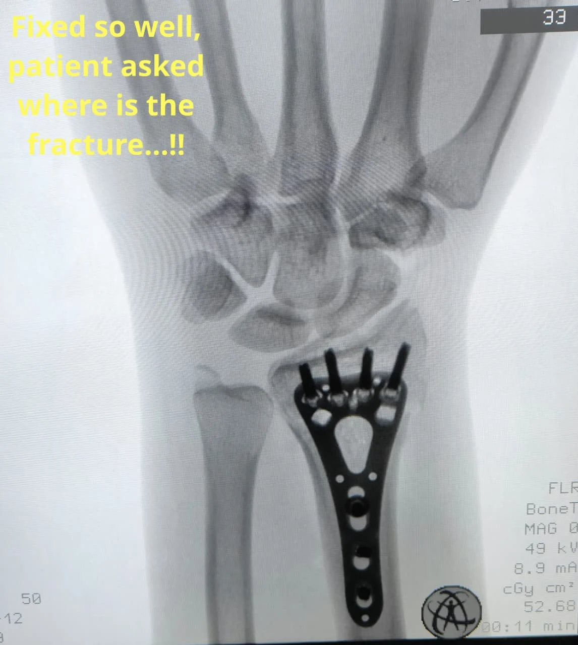Post Surgery X-Ray
