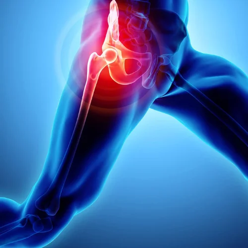 Hip Avascular Necrosis
