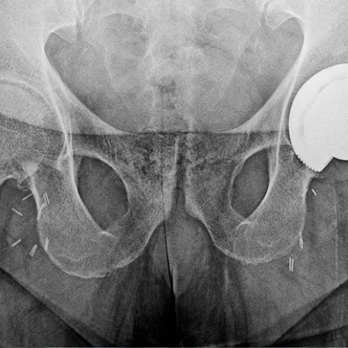 Hip Avascular Necrosis