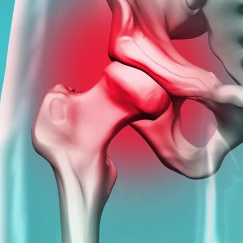 Hip Avascular Necrosis
