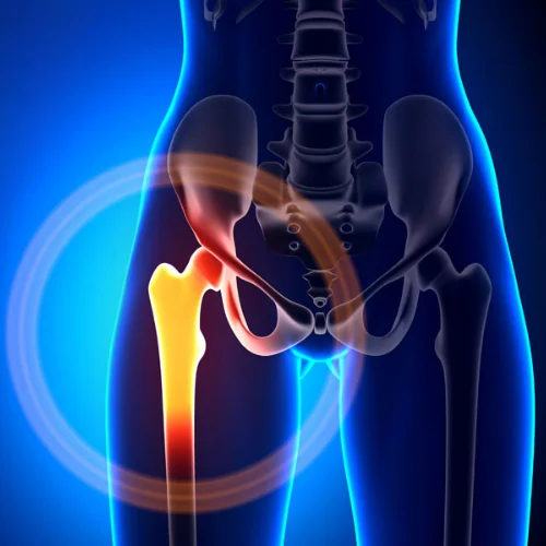 Hip Fracture