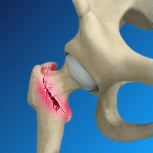 Hip Fracture