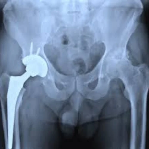 Hip Fracture