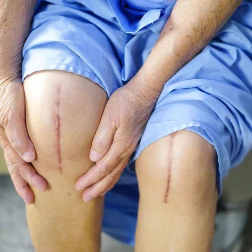 Knee Replacement
