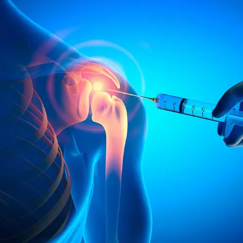 Joint Replacement