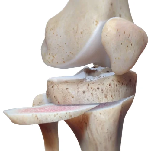 Knee Osteotomy