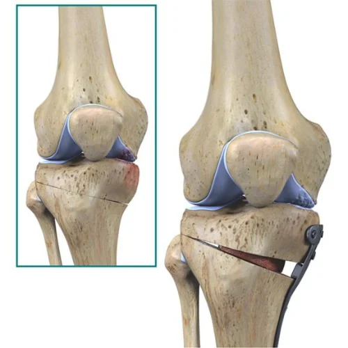 Knee Osteotomy