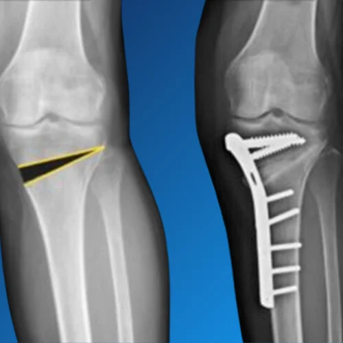 Knee Osteotomy