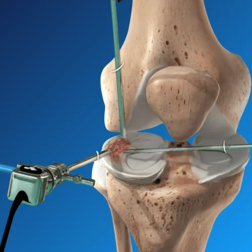 Meniscus