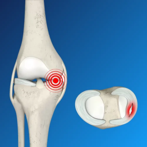 Meniscus