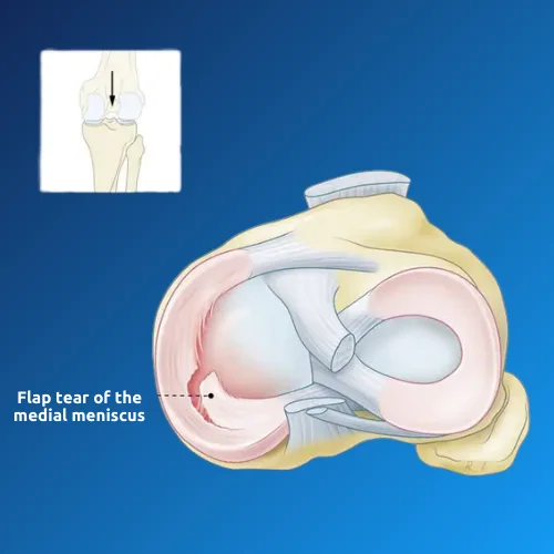 Meniscus