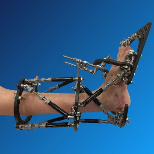 Orthopaedic Deformities