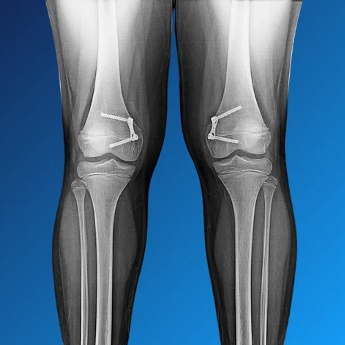 Orthopaedic Deformities